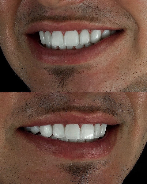 Foto 2 de Dr. Paulo Pantoja / Lentes em Resina / Facetas em Resina