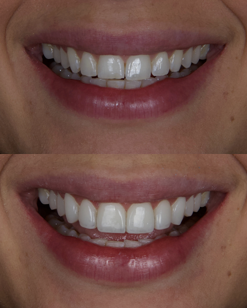 Foto 3 de Dr. Paulo Pantoja / Lentes em Resina / Facetas em Resina