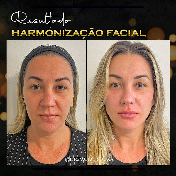 Foto 3 de Dr. Paulo Souza - Harmonização Facial