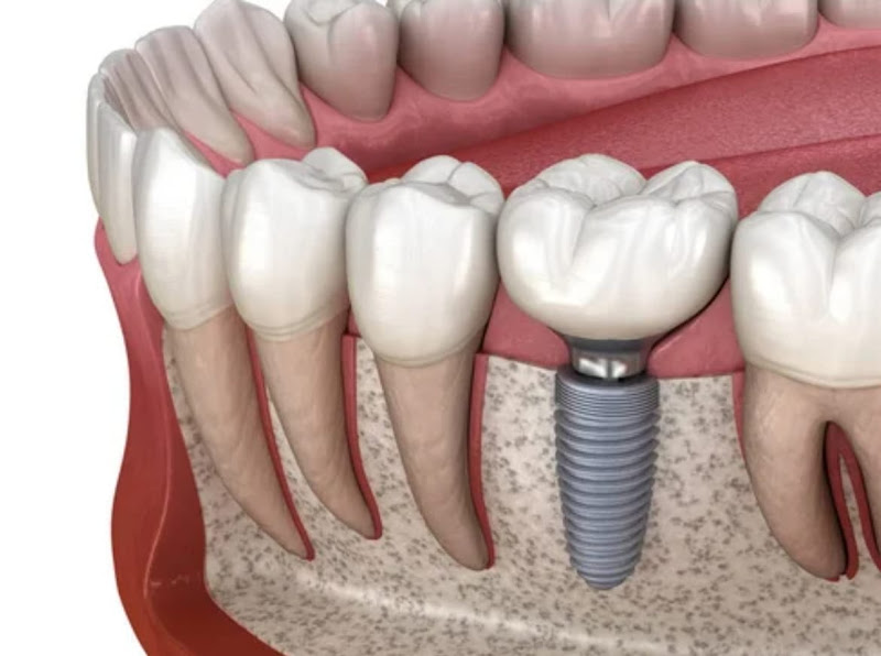 Foto 3 de Dr Paulo Trindade: Cirurgia Bucomaxilofacial e Implantes Dentários