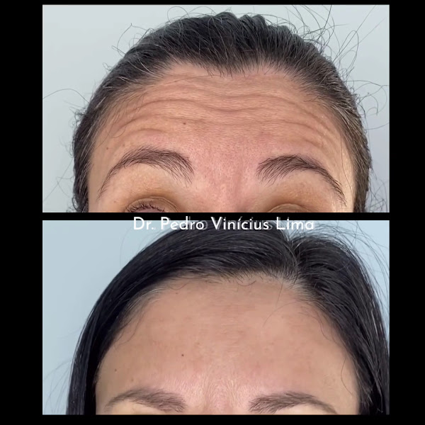 Foto 3 de Dr. Pedro Vinícius Lima Harmonização Facial e Botox