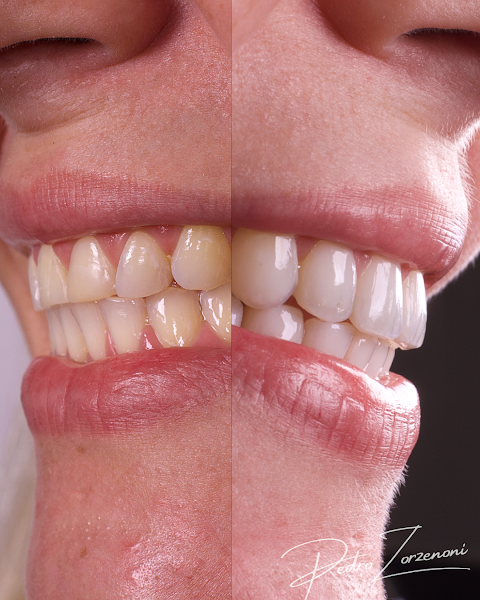 Foto 3 de Dr. Pedro Zorzenoni - Odontologia Estética | Facetas/Lentes em Resina