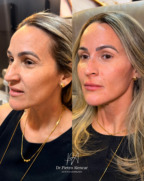 Foto 3 de Dr Pietro Alencar - Harmonização Facial em Salvador