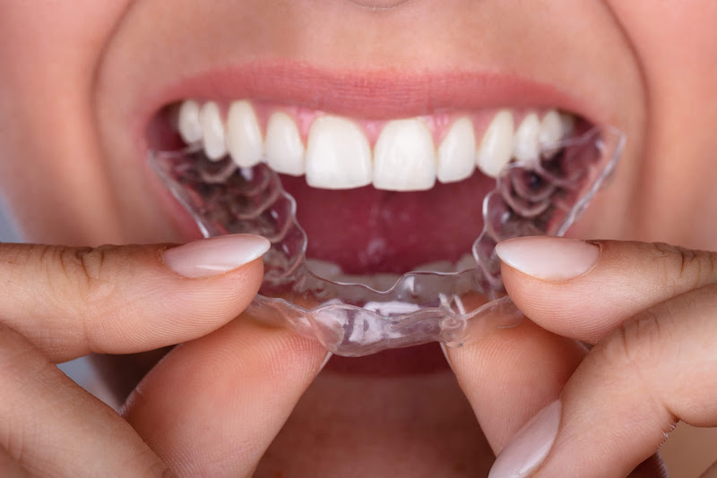 Foto 2 de Dr. Rafael Cepinho - Ortodontia Estética -INVISALIGN