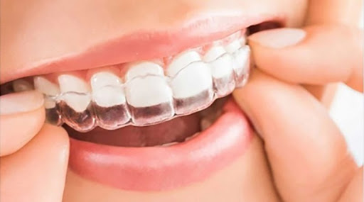 Foto 3 de Dr. Rafael Cepinho - Ortodontia Estética -INVISALIGN