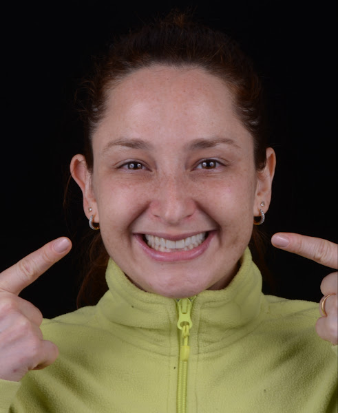 Foto 2 de Dr. Rafael Pocztaruk - Implante Dentário Porto Alegre l Lentes em Resina Premium l Faceta Porcelana l Protocolo de Implante