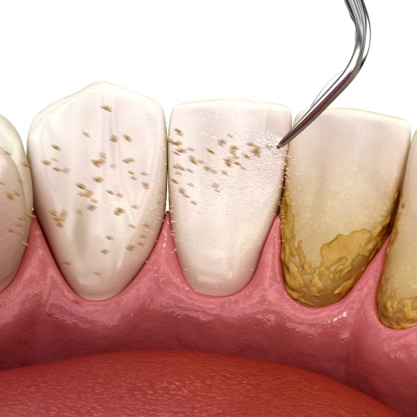 Foto 3 de Dr. Rafael Pocztaruk - Implante Dentário Porto Alegre l Lentes em Resina Premium l Faceta Porcelana l Protocolo de Implante