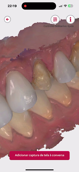 Foto 4 de Dr. Rafael Pocztaruk - Implante Dentário Porto Alegre l Lentes em Resina Premium l Faceta Porcelana l Protocolo de Implante