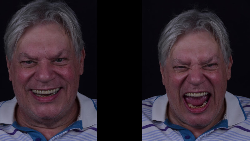 Foto 5 de Dr. Rafael Pocztaruk - Implante Dentário Porto Alegre l Lentes em Resina Premium l Faceta Porcelana l Protocolo de Implante