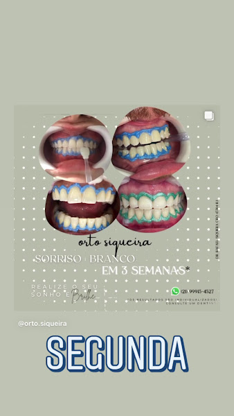 Foto 3 de Dr. Rafael Siqueira - Ortodontia Fixa/ Alinhadores INVISALIGN®/ Alinhadores SELF®/Nilópolis