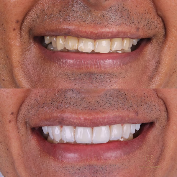Foto 2 de Dr. Rhuan Alexandre | Facetas de Resina | Dentista em João Pessoa