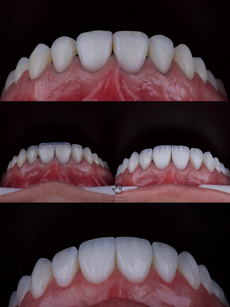 Foto 3 de Dr. Roger Borges - Facetas em resina - ARMONIE DENTAL CLINIC