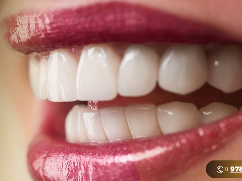 Foto 5 de Dr. Ruan Miranda | Dentista no Itaim Bibi | Alinhadores Invisíveis | Lentes de contato Dental | Implantes e Próteses Dentária