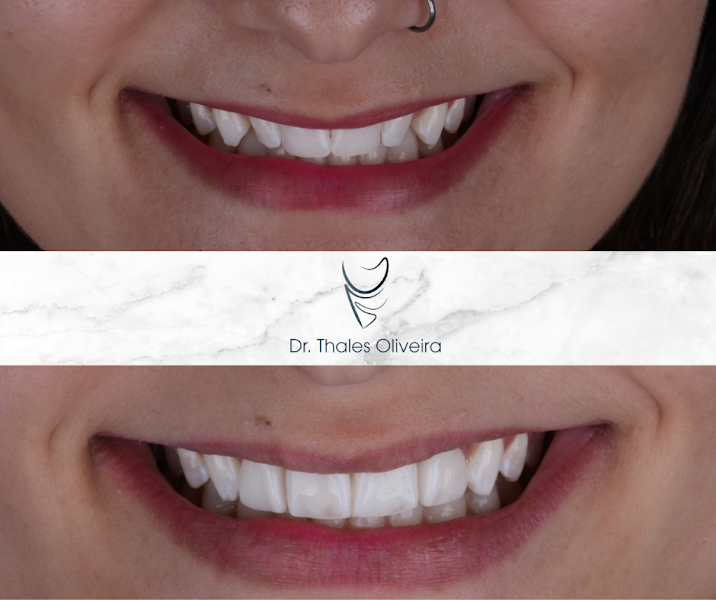 Foto 2 de Dr. Thales Oliveira | Lentes em resina | Betim-MG