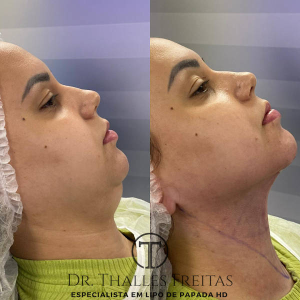Foto 2 de Dr. Thalles Freitas - Lipo de Papada HD - Clínica Harmovitta