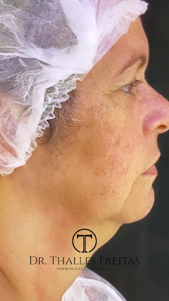 Foto 3 de Dr. Thalles Freitas - Lipo de Papada HD - Clínica Harmovitta
