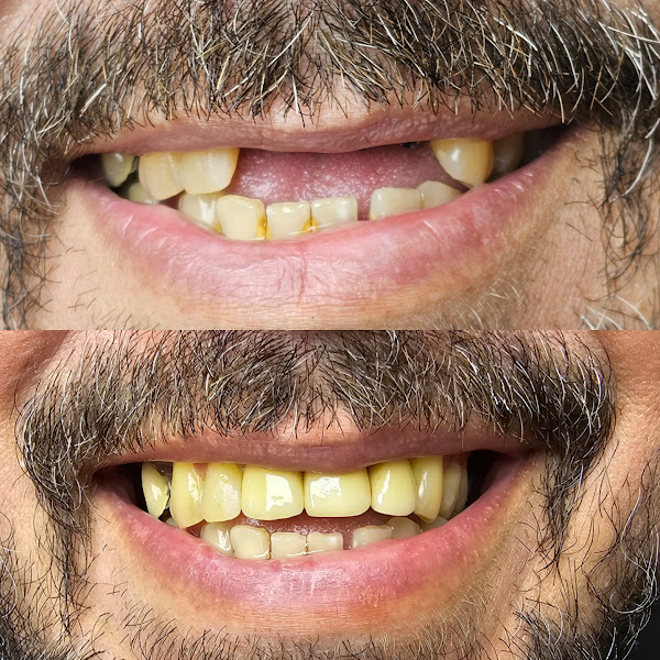Foto 2 de Dr. Thiago Lucena | Bucomaxilofacial | Implante dentário Zigomático | Siso | Estomatologia | Bradesco Saúde | Duque de Caxias