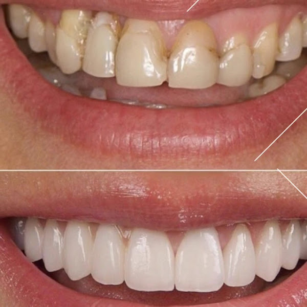 Foto 3 de Dr. Thiago Noronha | PHD em Odontologia | Implantes Dentários | Lentes de Porcelana | Alinhadores Invisalign