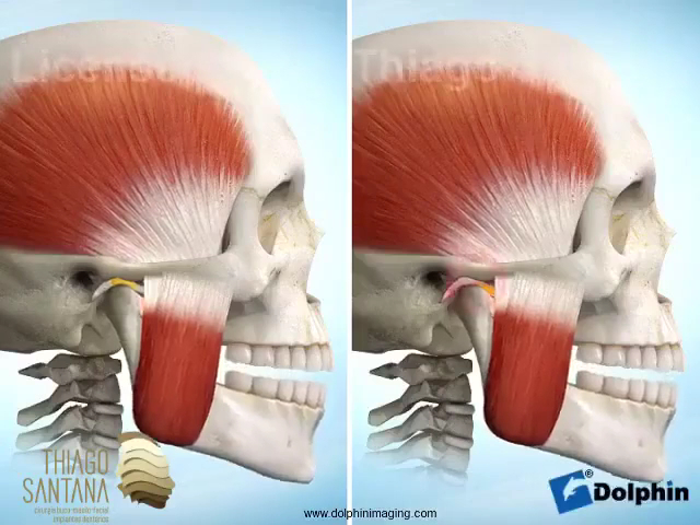 Foto 3 de Dr. Thiago Santana - Ortognática / Implantes Dentários / Sisos