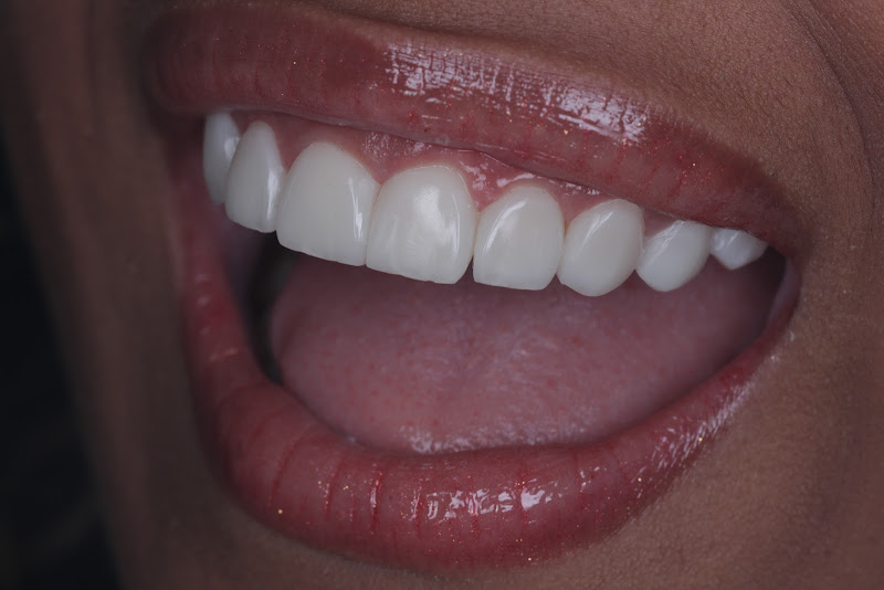 Foto 2 de Dr. Ulysses Vianna - Lentes em resina e Harmonização Facial