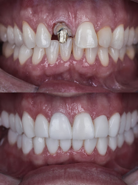 Foto 3 de Dr. Ulysses Vianna - Lentes em resina e Harmonização Facial