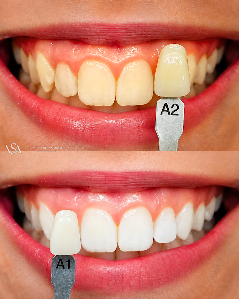 Foto 3 de Dr Victor Andrade - Clareamento Dental, Lentes em Resina e Reabilitação Oral em Ipanema