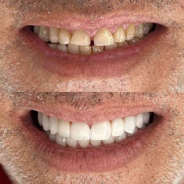 Foto 2 de Dr Vinícius Vieira | Dentista | lentes em resina | implante dentário | Petrolina