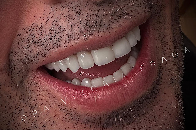 Foto 3 de Drª Vitória Fraga - Dentista | Lente de Contato Dental | Faceta em Resina