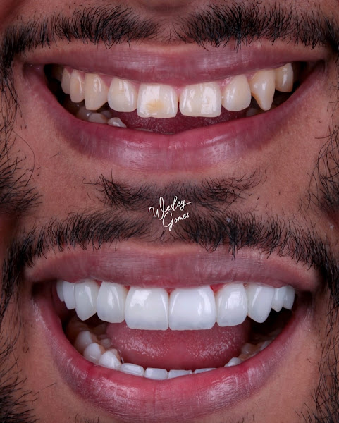 Foto 2 de Dr Wesley Gomes- Facetas em Resina
