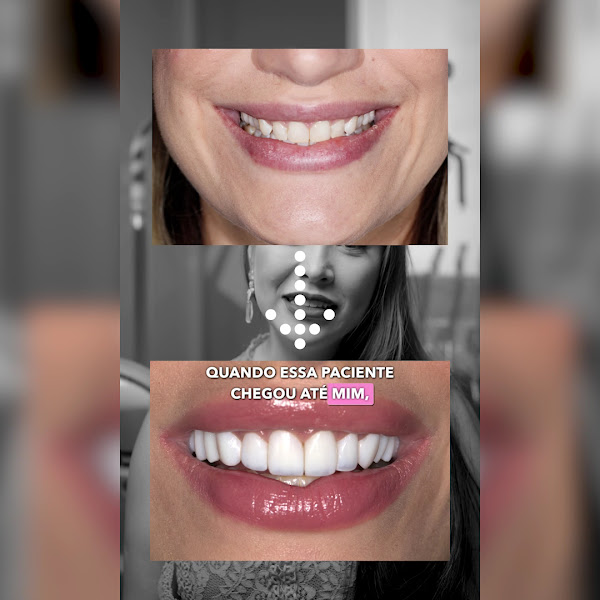 Foto 3 de Dra. Adrielle Ariosi I Siroma - Dentista | Facetas de Resina em Campo Grande