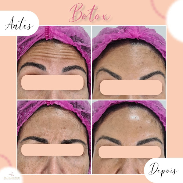 Foto 3 de Dra. Alana Magri | Harmonização Facial | Del Castilho | Botox | Sculptra | Radiesse | Preenchimento Facial