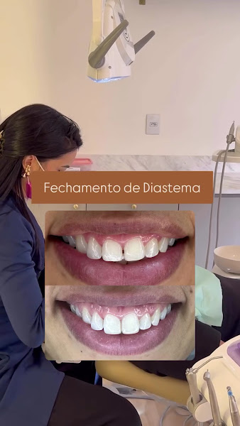 Foto 3 de Dra. Alana Rodrigues | Facetas de Resina em Uberlândia