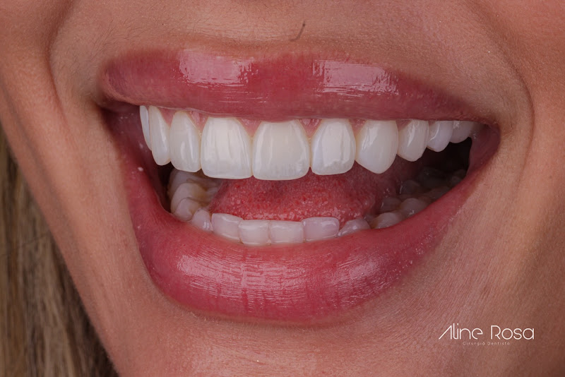 Foto 2 de Dra. Aline Rosa | Dentista | Lentes em Resina