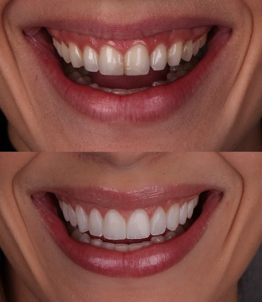 Foto 3 de Dra. Aline Rosa | Dentista | Lentes em Resina