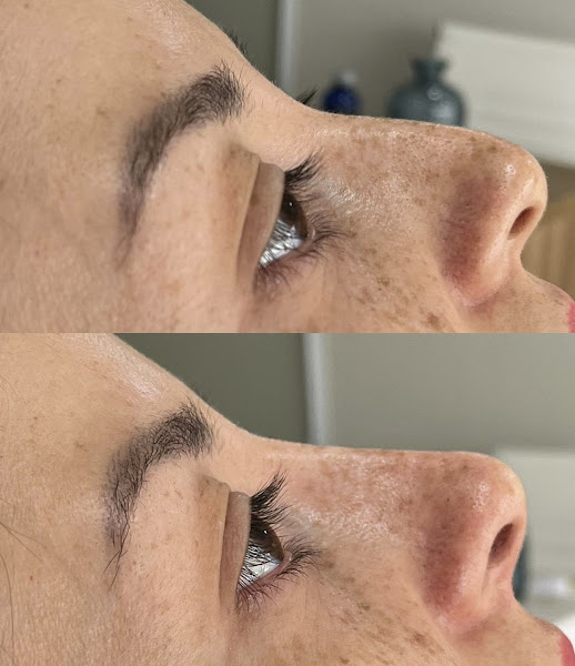 Foto 3 de Dra. Aline Souza - Beeautyclinic & Instituto | Rinomodelacao Jundiai | Preenchimento Labial | Harmonização Facial Fullface