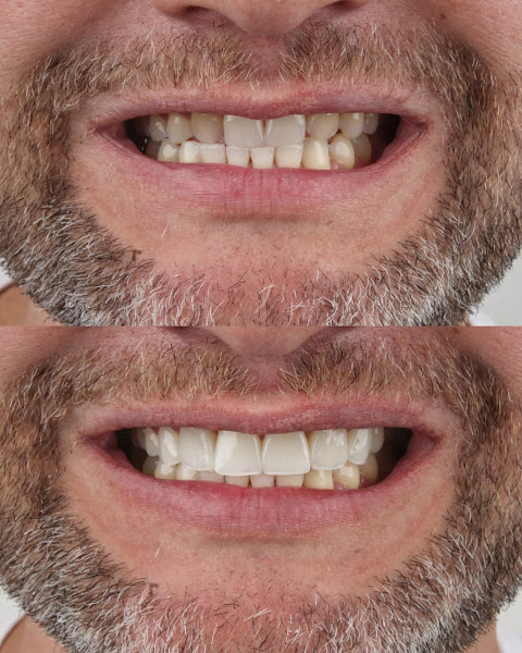 Foto 3 de Dra. Alini Caprini - Cirurgiã Dentista