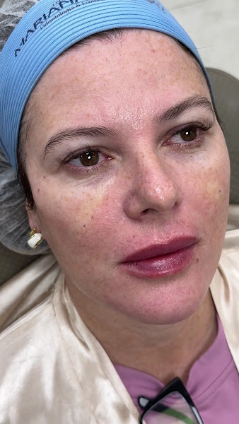 Foto 3 de Dra. Alline Valeriano | Harmonização Orofacial