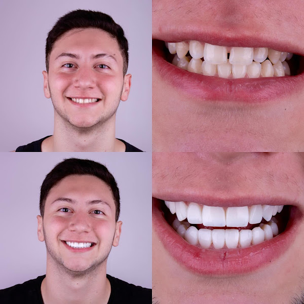 Foto 2 de Dra. Amanda Gomes | Lentes em porcelana e resina | Santana - São Paulo