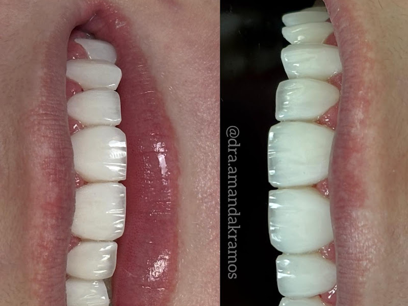 Foto 10 de Dra Amanda Medeiros | Lentes Dentárias | Implantes | Aparelhos Invisíveis | Zona Norte - SP