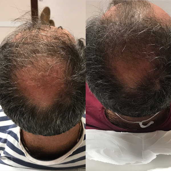Foto 2 de Dra. Ana Betina Biomédica Esteta- Harmonização Facial e corporal.