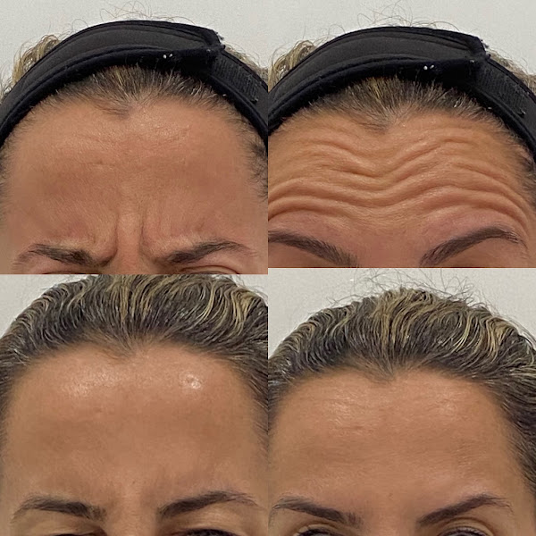 Foto 3 de Dra. Ana Betina Biomédica Esteta- Harmonização Facial e corporal.