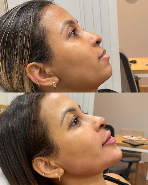 Foto 3 de Dra. Ana Carolina Wittmann | Harmonização Facial