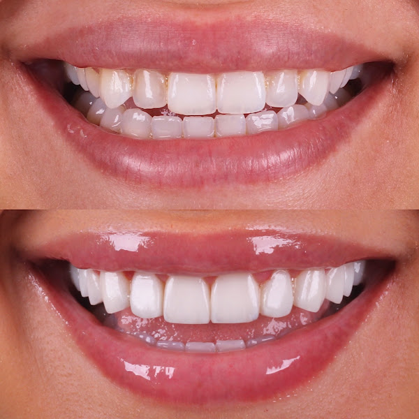 Foto 3 de Dra. Ana Dias - Dentista | Lentes em Resina