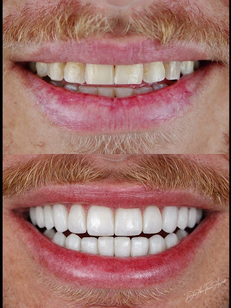 Foto 3 de Dra. Ana Flávia Azevedo | Facetas em Resina | Belo Horizonte