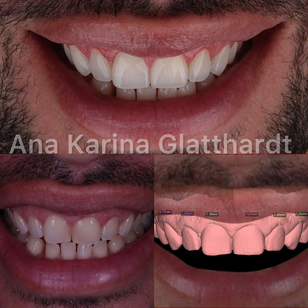 Foto 2 de Dra. Ana Karina Glatthardt - Especializada em Implantodontia, Protesista e Cirurgias Gengivais na Tijuca - RJ