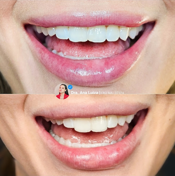 Foto 3 de Dra. Ana Luiza Donatti | Odontologia Biológica e Harmonização Orofacial