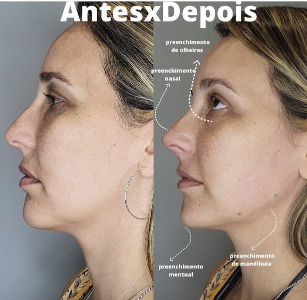 Foto 3 de Dra Ana Luiza Ripoll | Harmonização Orofacial