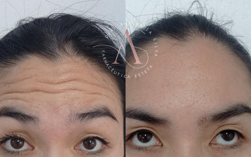 Foto 3 de Dra. Ana Paula Silva - Harmonização Facial