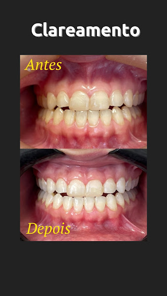 Foto 3 de Dra. Ana Paula Trombin - Invisalign (Aparelho Invisível)