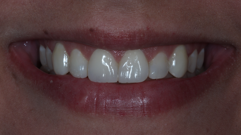 Foto 2 de Dra. Ananda Jasson- Dentista. Tratamento de canal- Clareamento dental- Prótese Dentária- Cirurgias-